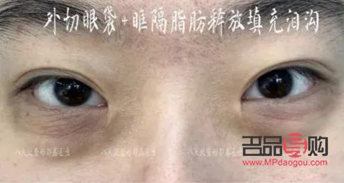 眼袋大是哪里出问题了(眼睛肿眼袋大是哪里出问题了)