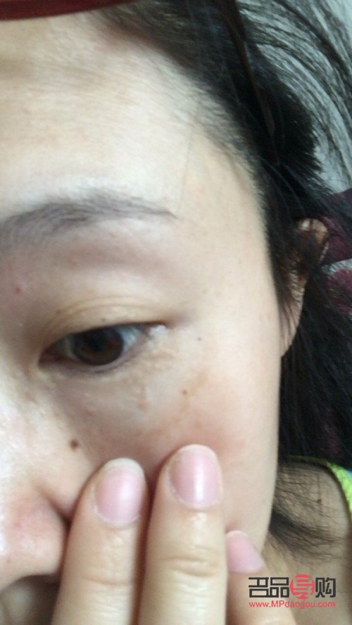 上眼皮长了个疙瘩图片(上眼皮长了个疙瘩图片不疼不痒)