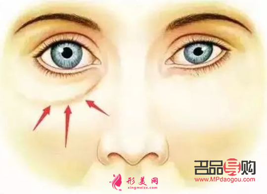 眼袋手术完全恢复要多久(眼袋手术完全恢复要多久时间)