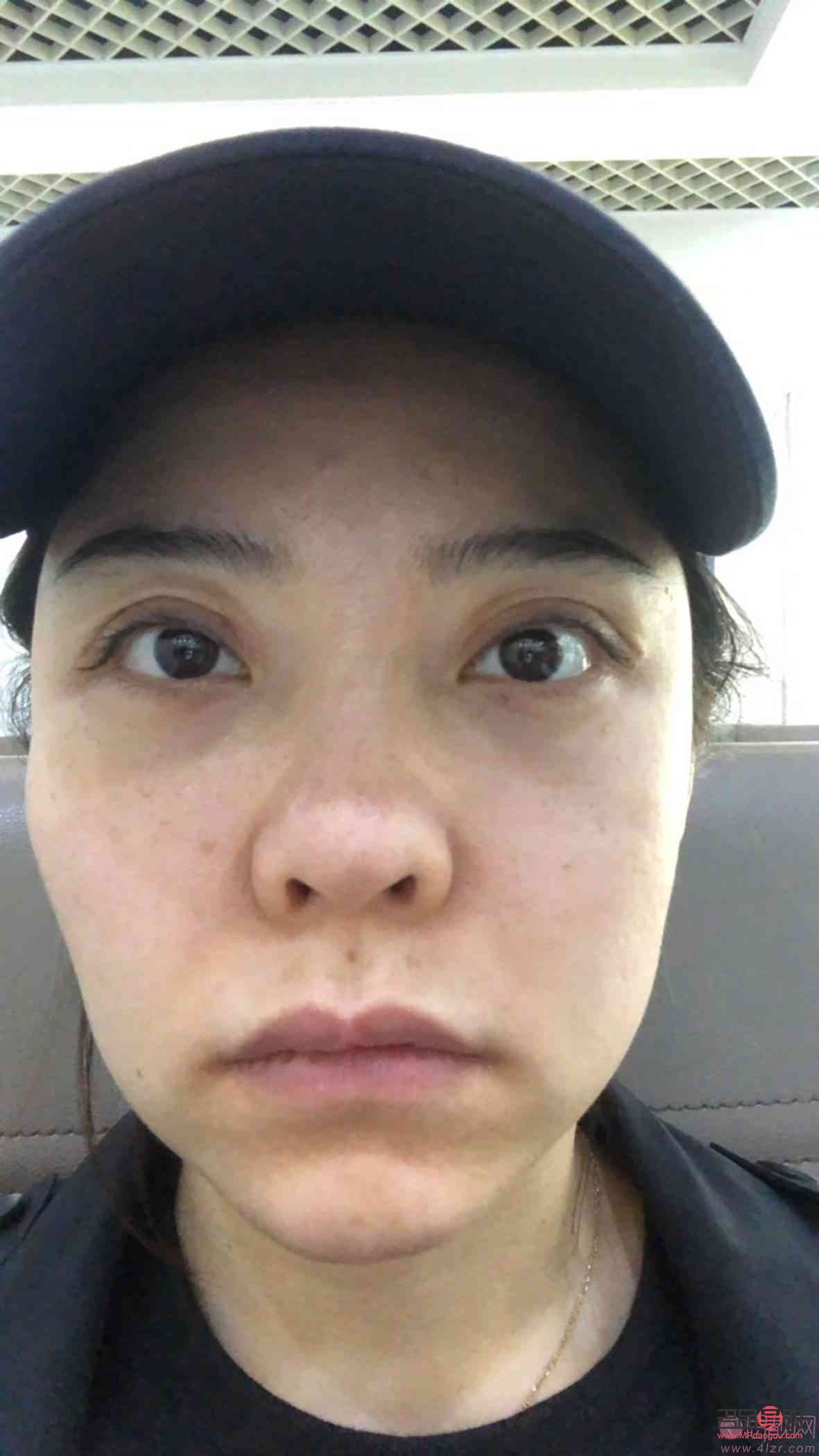 <h3>眼睛大小不一，手术可否解决？</h3>