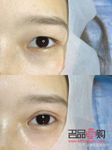 眼部抽脂有什么风险和后遗症(肿眼泡去脂肪手术多少钱)