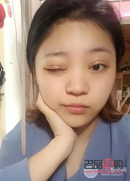 双眼皮手术20天恢复图详解