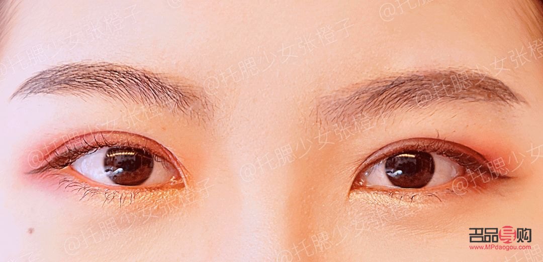 双眼皮手术带来的巨大变化：如何应对与接受自我新面貌