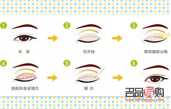 <h3>提眉与埋线双眼皮：可否一并施行？</h3>
