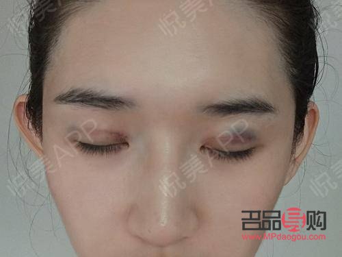 提眉与埋线双眼皮：可否一并施行？