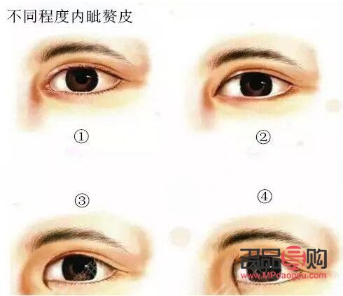 眼皮松全切双眼皮会不会塌(眼皮松全切双眼皮会不会塌下去)