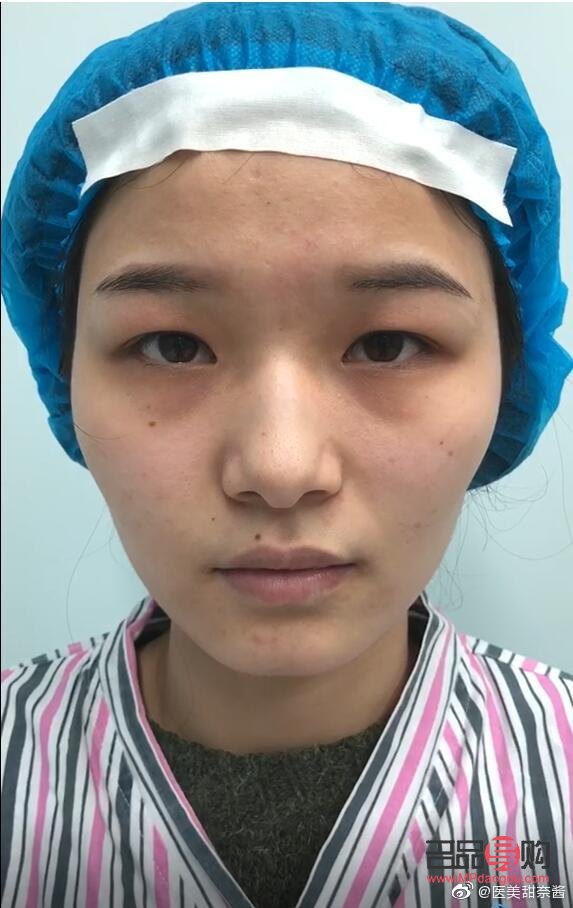 眼皮松全切双眼皮会不会塌(眼皮松全切双眼皮会不会塌下去)