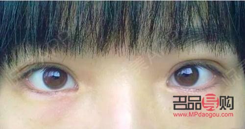 全切双眼皮与眼综合：深度解析两者的差异