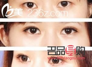 割双眼皮对身体有什么影响(割双眼皮对身体有什么影响吗)