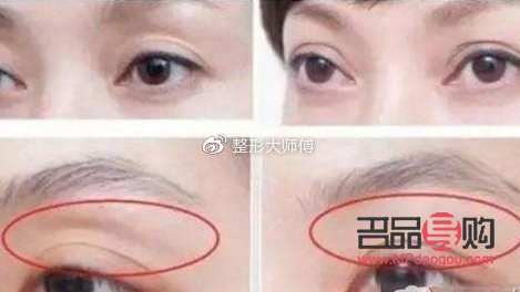 眼窝凹陷可以填充吗？解析眼部填充手术