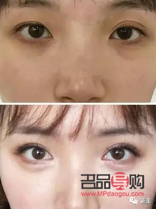 <h3>欧式双眼皮的魅力与特色</h3>