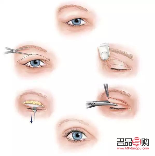 <h3>欧式双眼皮的魅力与特色</h3>