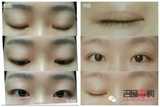 <h3>内双是否可以割双眼皮及手术费用详解</h3> <h3>内双是否可以割双眼皮及手术费用详解</h3>