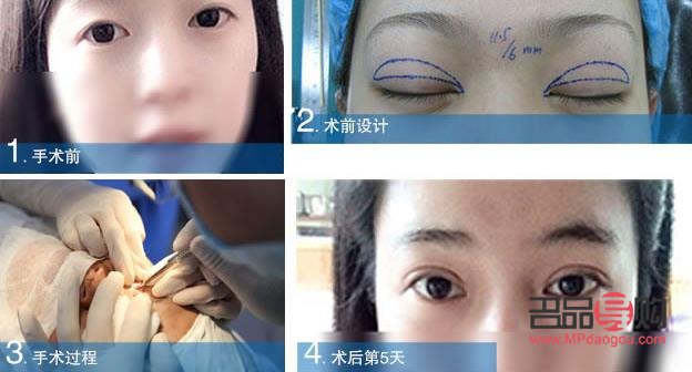 全切双眼皮恢复过程全解析