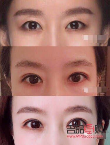 全切双眼皮恢复过程全解析