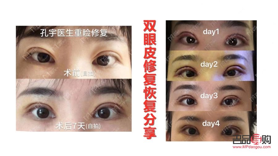 全切双眼皮恢复过程全解析