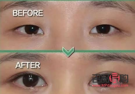做哪种双眼皮(做哪种双眼皮是永久的)