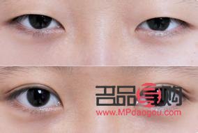做哪种双眼皮(做哪种双眼皮是永久的)