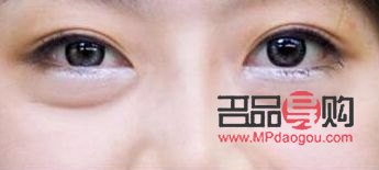 后天肿眼泡怎么消除好几年了图片(后天肿眼泡怎么消除好几年了图片) 后天肿眼泡怎么消除好几年了图片(后天肿眼泡怎么消除好几年了图片)