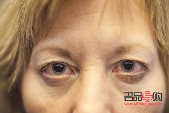 泪沟消除秘籍：告别疲惫，重拾青春明眸