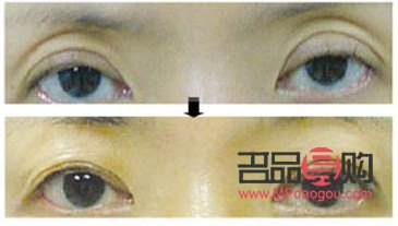 眼窝凹陷严重图片(眼窝凹陷严重图片儿童)