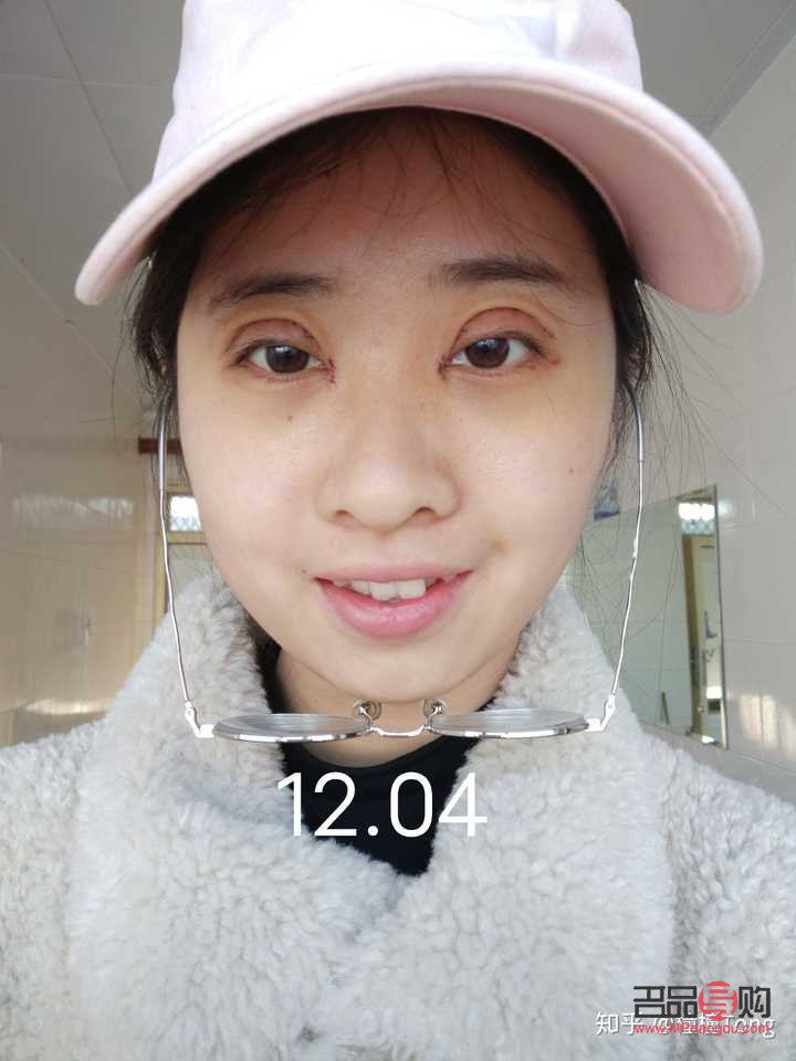 双眼皮全切恢复期要多久才自然(双眼皮全切恢复期要多久才自然好)