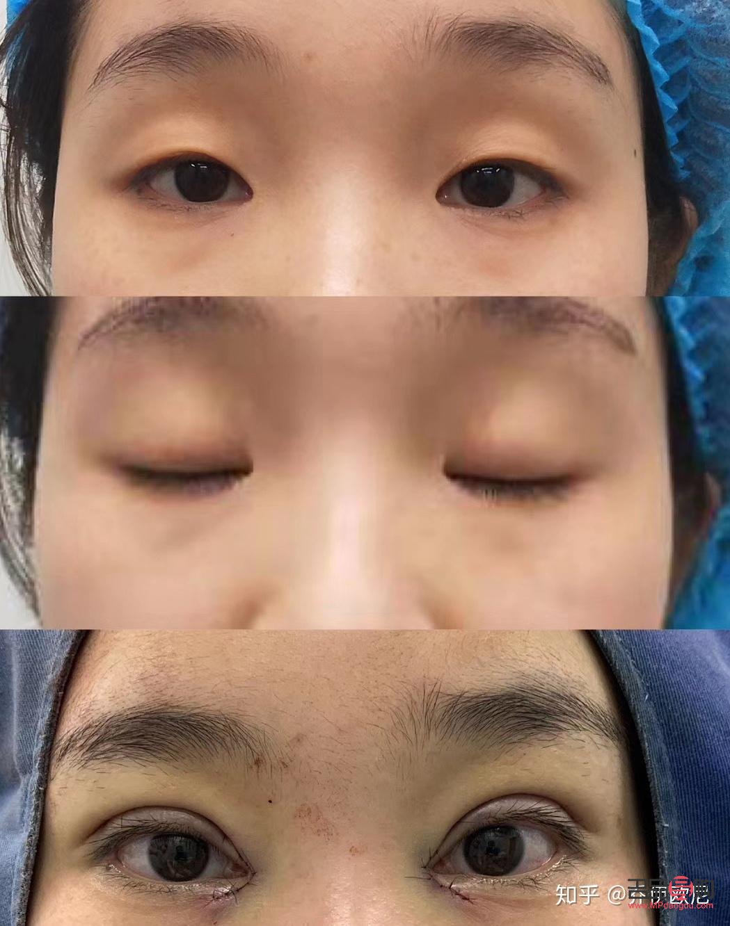 双眼皮全切恢复期要多久才自然(双眼皮全切恢复期要多久才自然好)