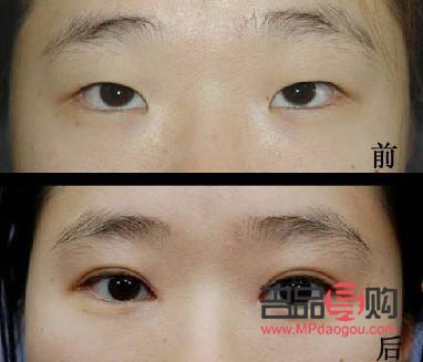 割的双眼皮能维持几年(埋线双眼皮20年后图片)