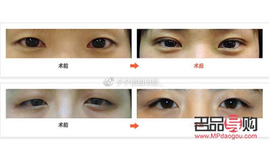 割的双眼皮能维持几年(埋线双眼皮20年后图片)