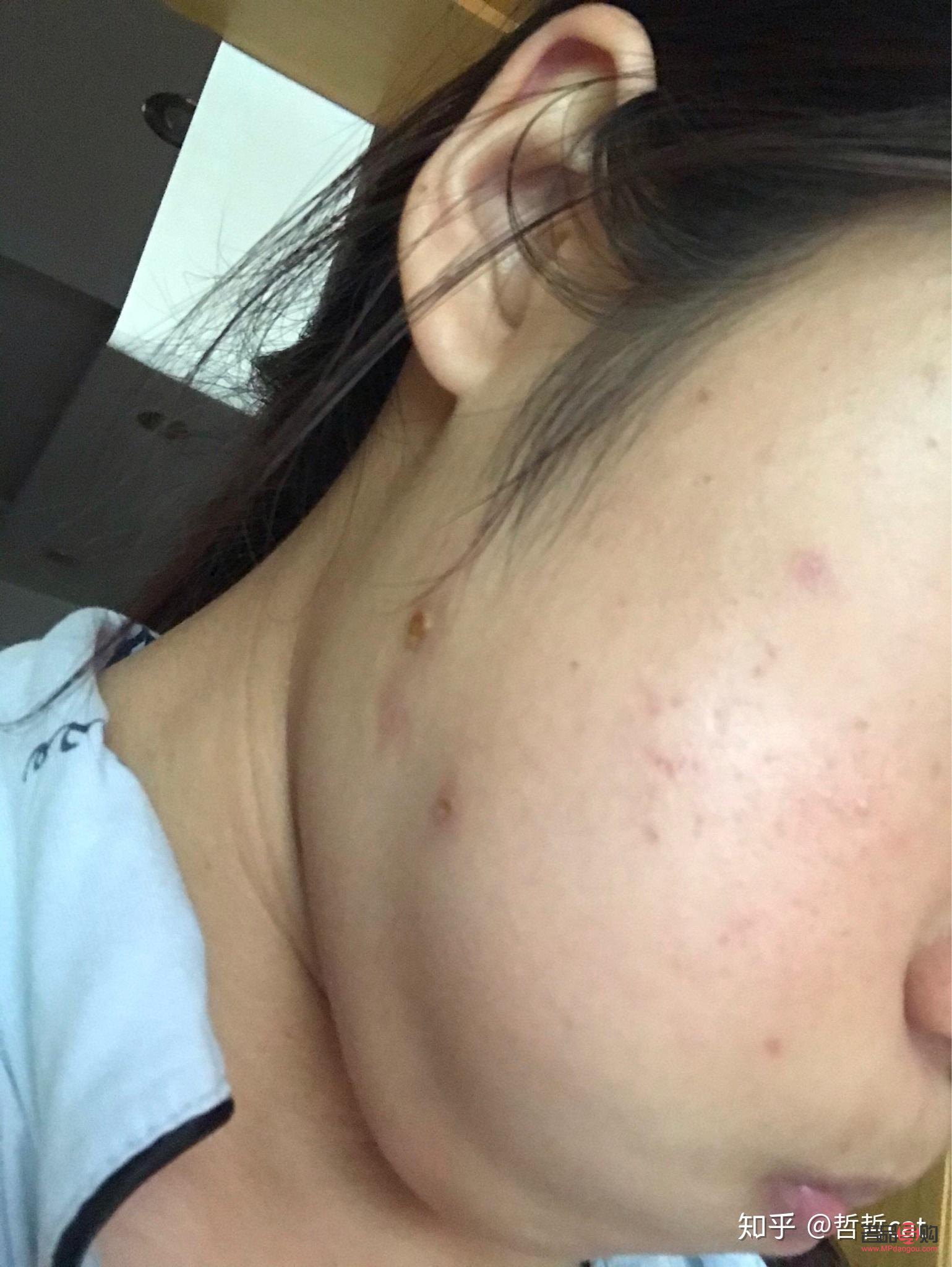 美容院点痣怎么点(美容院点痣怎么点的)