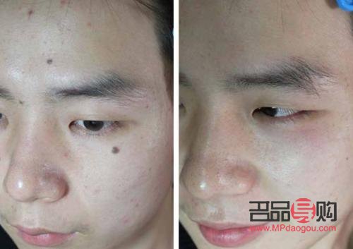 美容院点痣怎么点(美容院点痣怎么点的)