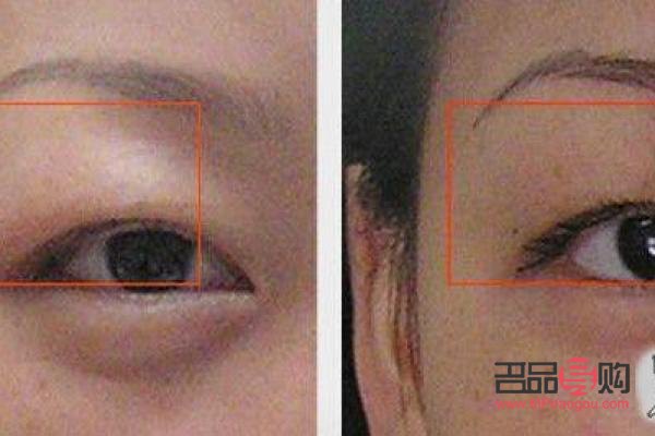 眼睛陷进去怎么办(眼睛陷进去怎么办小妙招)