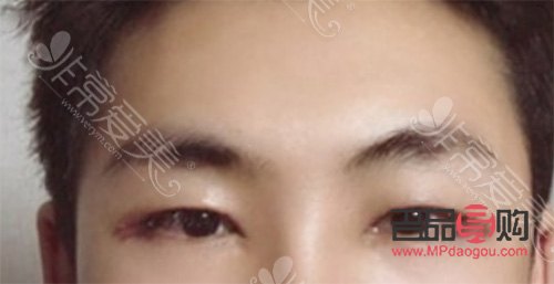 <h3>男人是否应该割双眼皮？探讨男性双眼皮手术的利与弊</h3>