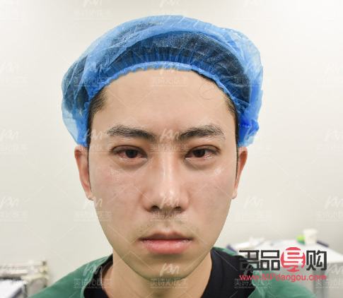 <h3>男人是否应该割双眼皮？探讨男性双眼皮手术的利与弊</h3>