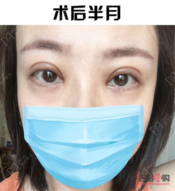 全切双眼皮注意事项(全切双眼皮注意事项及护理) 全切双眼皮注意事项(全切双眼皮注意事项及护理)