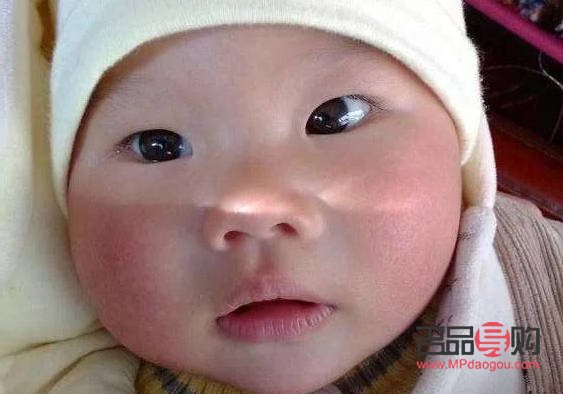 斗鸡眼可以矫正吗(天生斗鸡眼可以矫正吗)