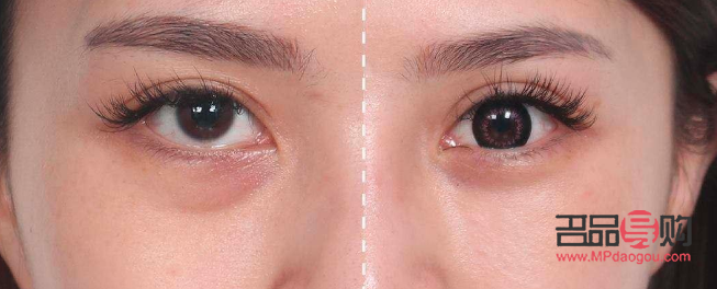 割眼袋增生了怎么办(割眼袋增生了怎么办图片)