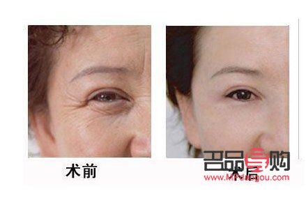 眼部超声刀怎么做(眼部超声刀做完什么时候见效果)