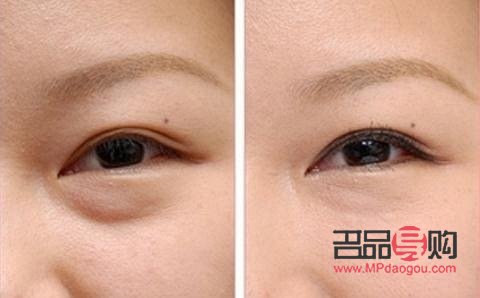 眼部超声刀怎么做(眼部超声刀做完什么时候见效果)