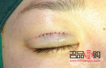 不适合做双眼皮埋线的人群