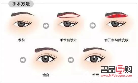 双眼皮下垂提眉好还是全切好(提眉手术多大年龄做最好)
