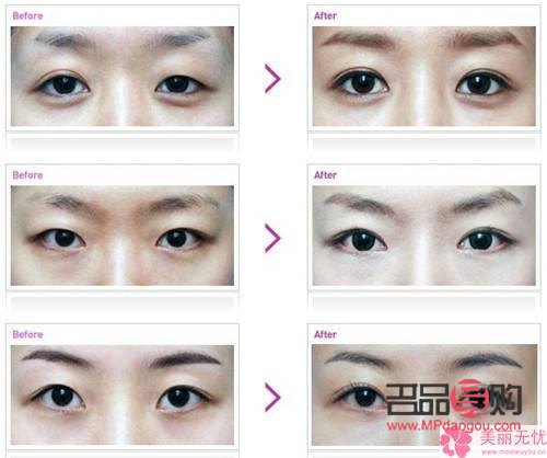 <h3>翘睫术双眼皮效果能持续多久?</h3> <h3>翘睫术双眼皮效果能持续多久?</h3>