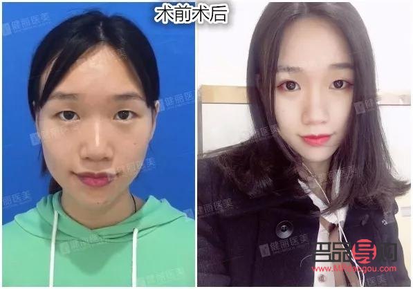 明星双眼皮做的什么型(明星双眼皮做的什么型状)