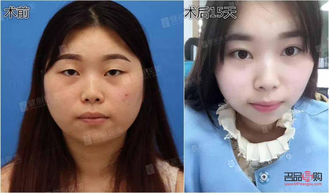 明星双眼皮做的什么型(明星双眼皮做的什么型状)