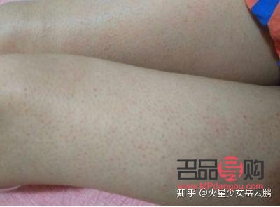 身体鸡皮肤怎么护理(身上的鸡皮肤怎么治)