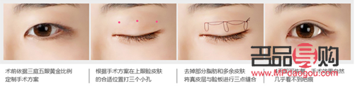 <h3>割双眼皮大小眼：手术风险与美学考量</h3>