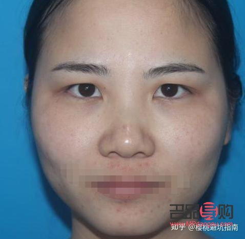 <h3>割双眼皮大小眼：手术风险与美学考量</h3>