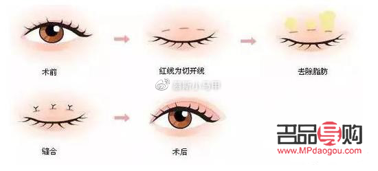 现在流行什么双眼皮技术(现在流行什么双眼皮技术呢)