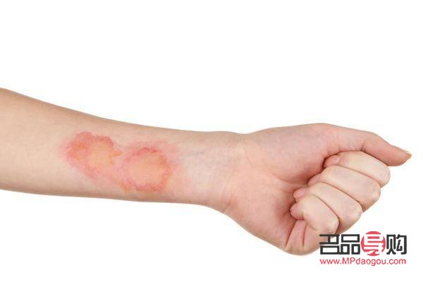 身体烫伤怎么护理好(身上烫伤)