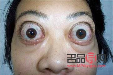 甲亢眼睛突出做手术要多少费用(甲亢眼睛突出做手术要多少费用呢) 甲亢眼睛突出做手术要多少费用(甲亢眼睛突出做手术要多少费用呢)